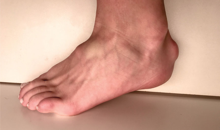 fluid in heel of foot